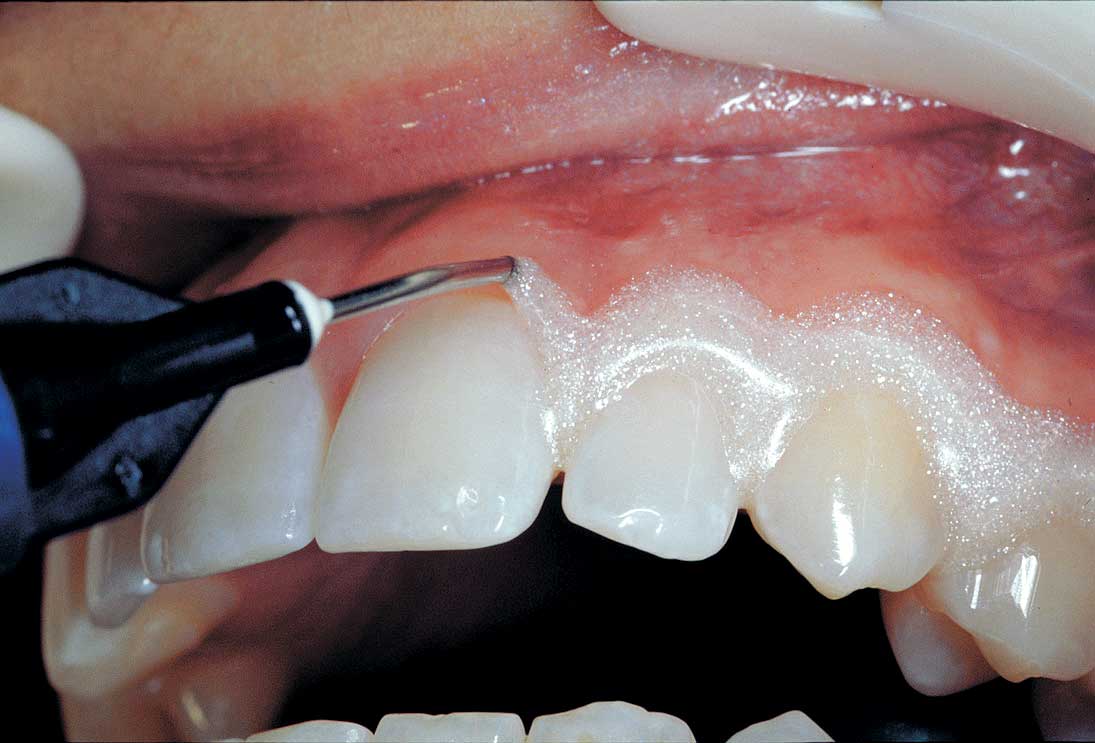 Нанесение специального геля на дёсна