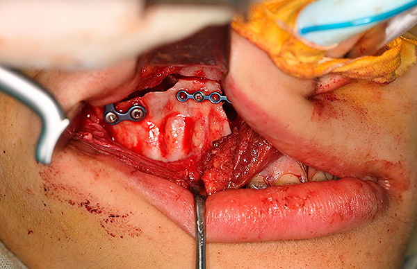 Хирургическое лечение неправильного прикуса - фото 5