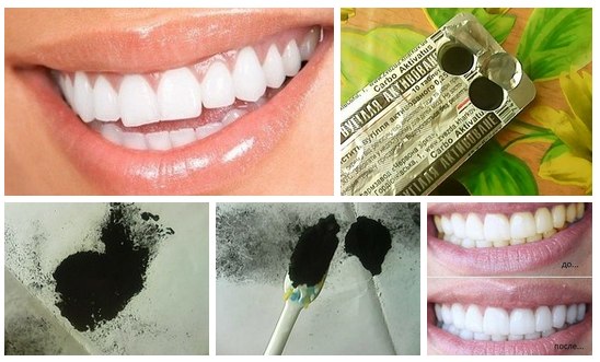 Отбеливание зубов при помощи активированного угля