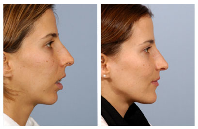 Открытый прикус: причины, симптомы, лечение, профилактика - фото 2