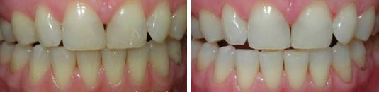 Оттенок зубов до и после лазерного отбеливания 