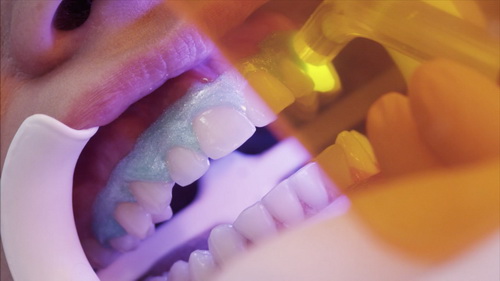 Отбеливание зубов при помощи зеленого лазера