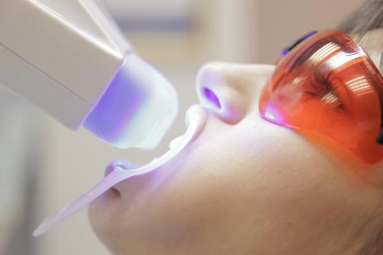 Процедура фотообеливания зубов