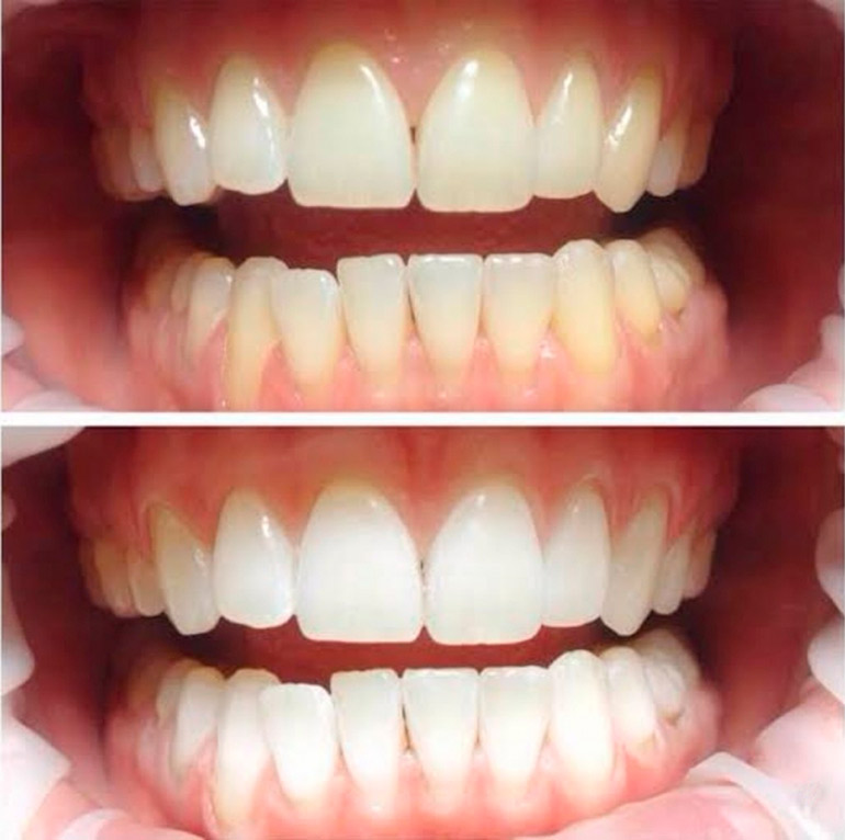 Цвет эмали до и после отбеливания зубов лампой Zoom