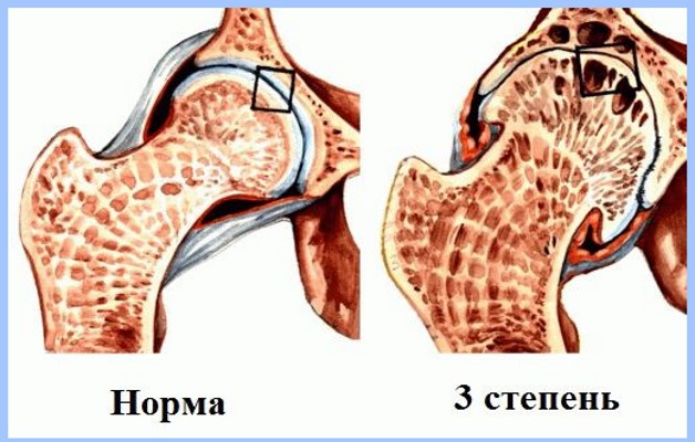 3 степени разрушения