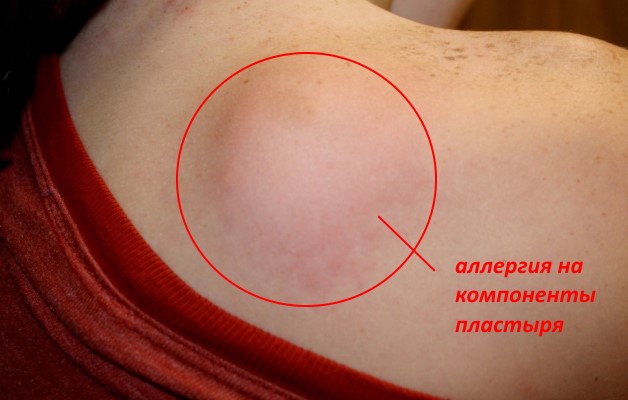 аллергия на пластырь