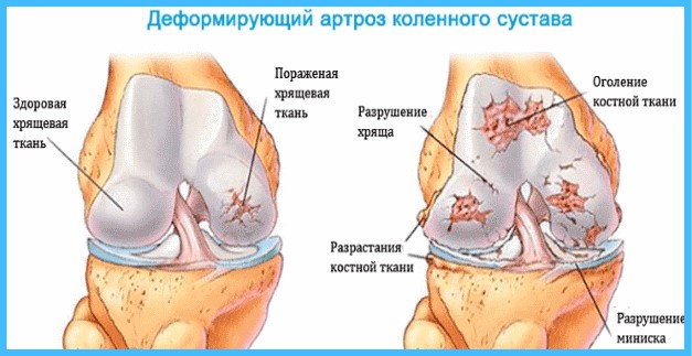 деформирующий артроз