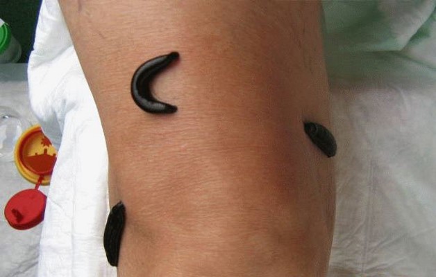 лечение пиявками