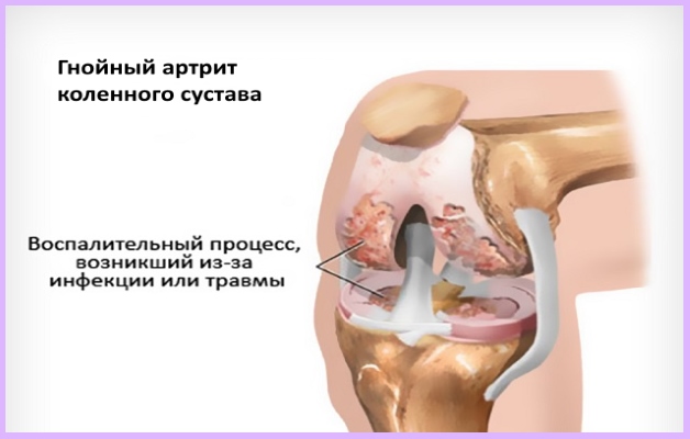 гнойный артрит коленного сустава