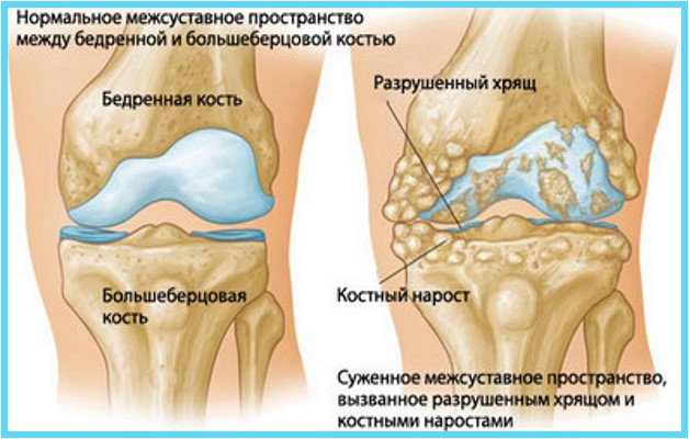 гонартроз 2 степени