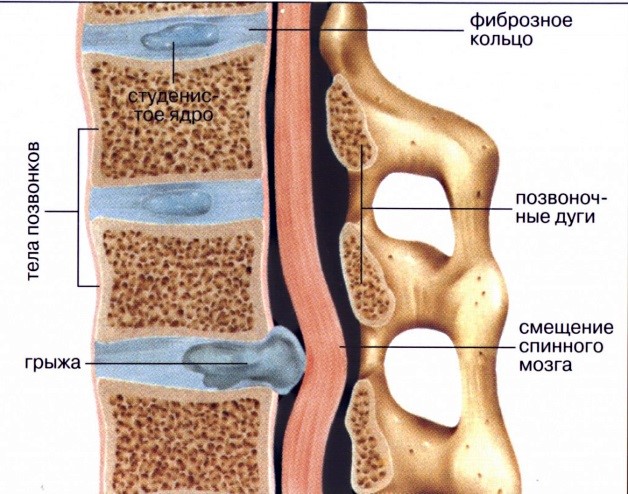 грыжа межпозвоночного диска