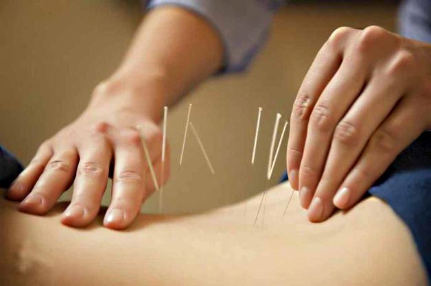 иглотерапия пояснично-кресцового отдела