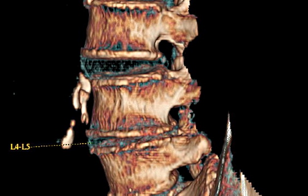 КТ поясничного отдела