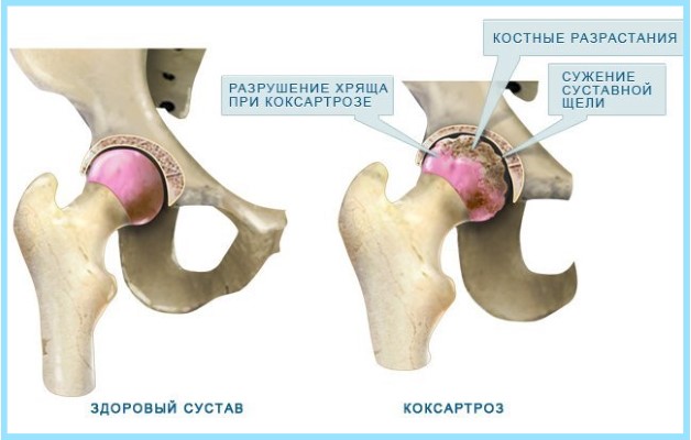 коксартроз тазобедренного сустава 3 степени