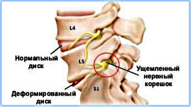 корешковый синдром при остеохондрозе