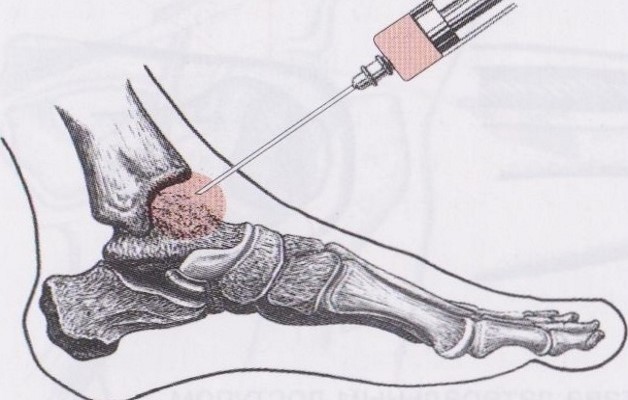 Лечение артроза