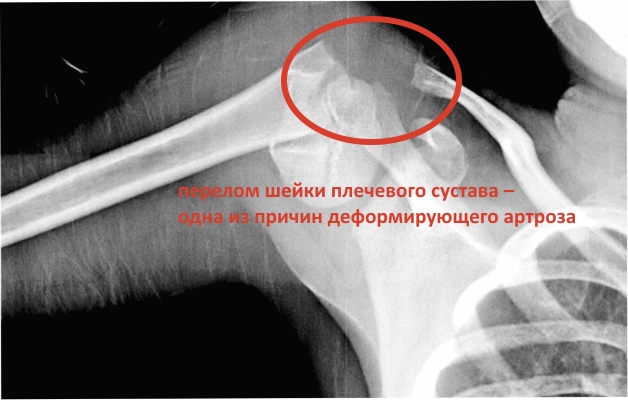 перелом шейки плеча