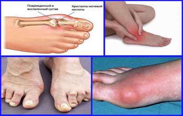 симптомы артроза стопы