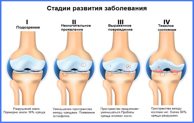 стадии болезни