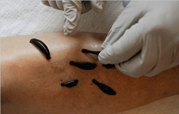 точки для герудотерапии