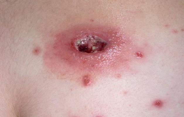 абсцесс после укола