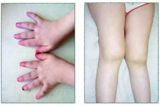 Вид аллергической реакции