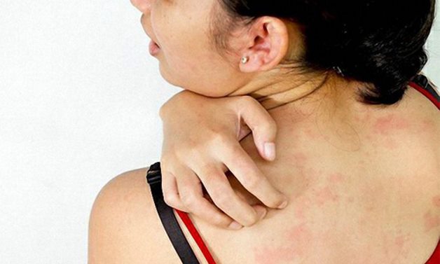 аллергия на китайский пластырь