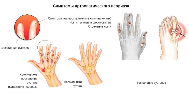 Вальгусная деформация – симптом псориаза