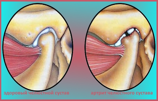 артрит челюсти