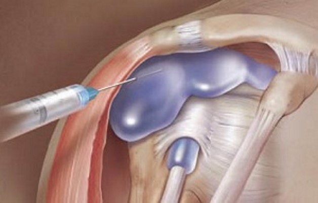 лечение артрита плечевого сустава