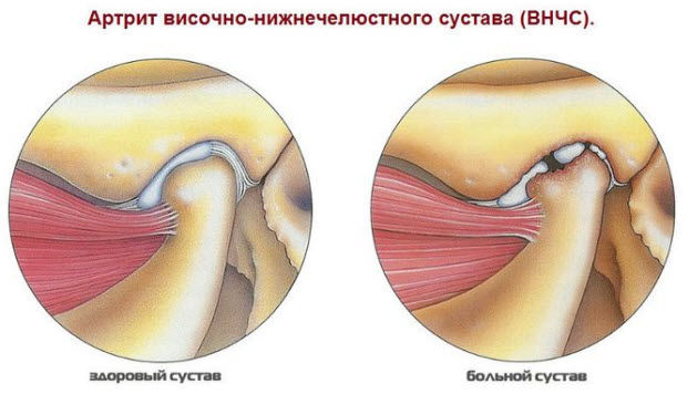 Нижнечелюстной сустав