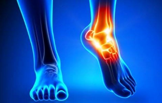 артроз голеностопного сустава