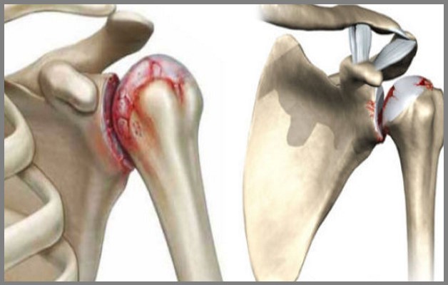 Артроз плечевого сустава