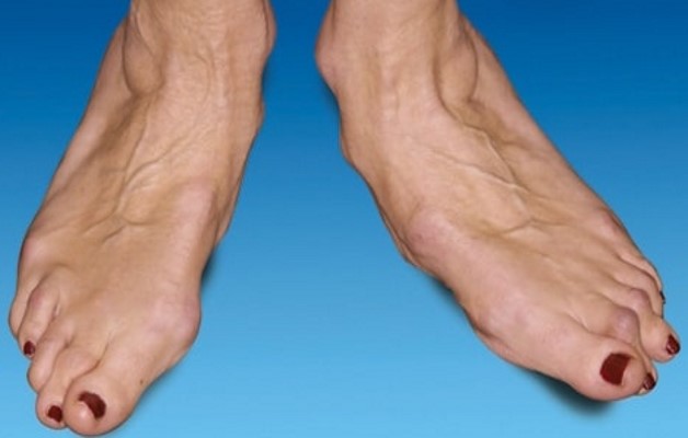 артроз стопы