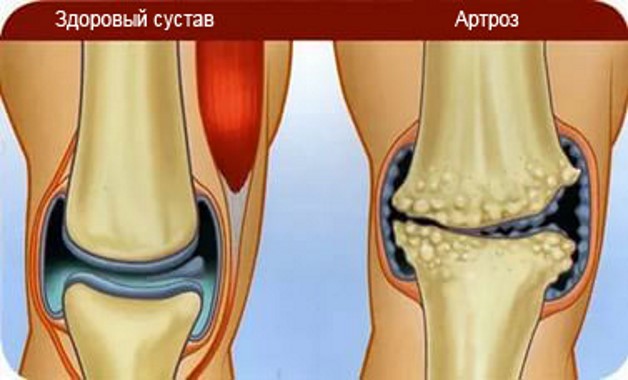 артроз