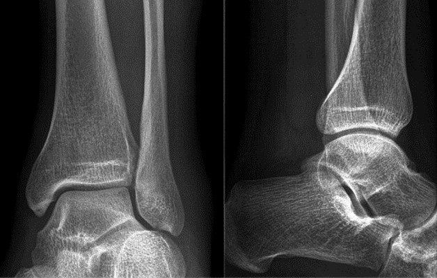 артроз голеностопного сустава