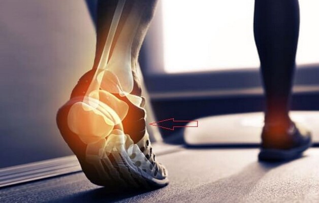 артроз стопы