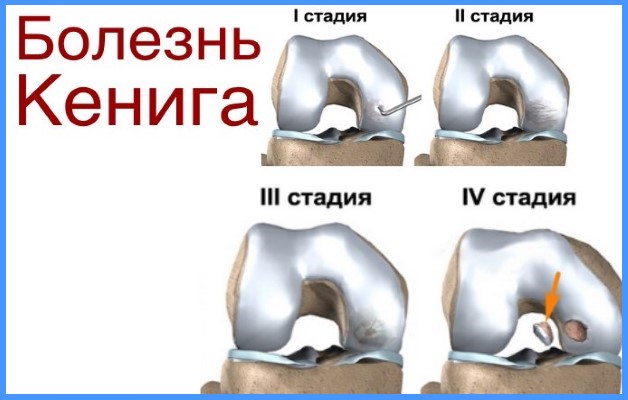 болезнь Кенига