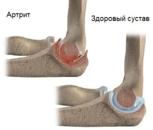 Пораженный локтевой сустав