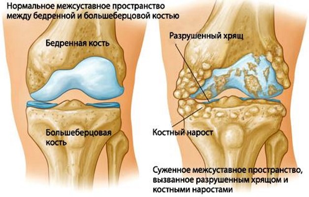 деформация сустава