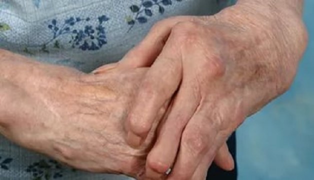 деформация суставов