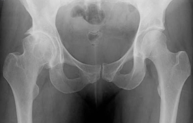 диспластический коксартроз рентген