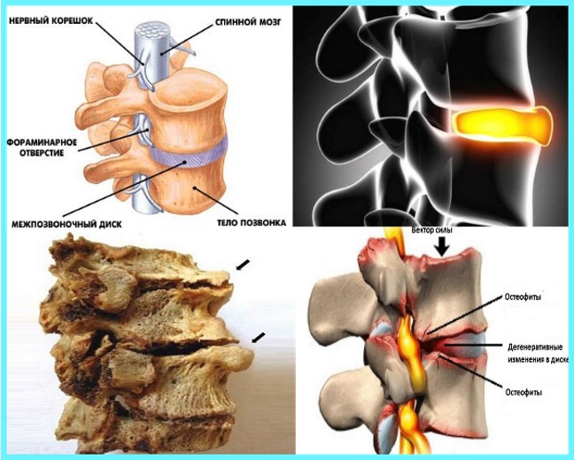 дистрофические изменения в позвоночнике