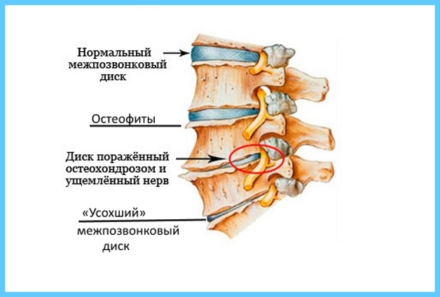 дистрофия диска при остеохондрозе