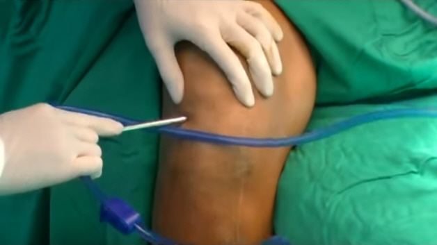 Процесс дренирования