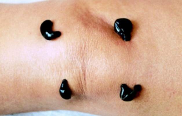 гирудотерапия при артрозе колена