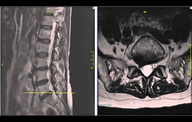 грыжа межпозвонковая в пояснице
