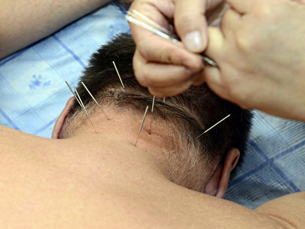 иглоукалывание при шейном остеохондрозе