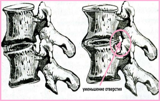изменение тел позвонков