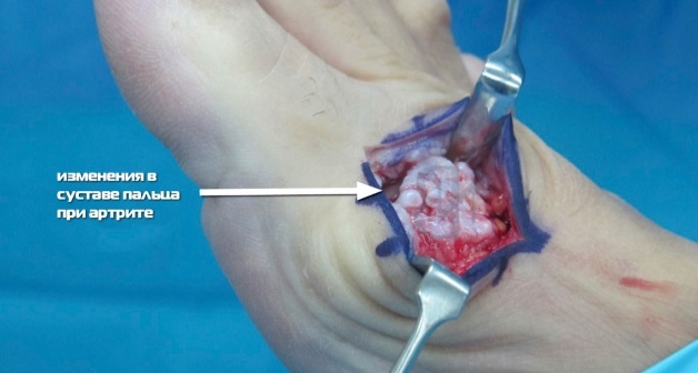 Изменения в суставе при артрите